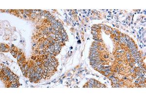 Immunohistochemistry of paraffin-embedded Human colon cancer tissue using Claudin 10 Polyclonal Antibody at dilution 1:50 (CLDN10 anticorps)