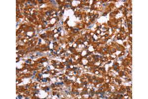 Immunohistochemistry of Human gastric cancer using GAGE12I Polyclonal Antibody at dilution of 1:30 (G Antigen 12I anticorps)