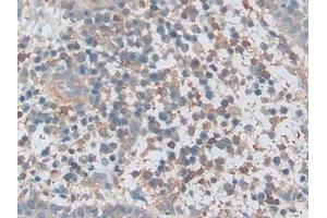 Detection of PKBg in Human Skin cancer Tissue using Polyclonal Antibody to Protein Kinase B Gamma (PKBg)