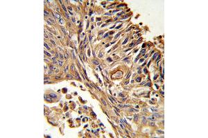 Formalin-fixed and paraffin-embedded human lung carcinoma reacted with IL18RAP Antibody (N-term), which was peroxidase-conjugated to the secondary antibody, followed by DAB staining. (IL18RAP anticorps  (N-Term))