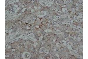 Immunohistochemical analysis of parafin-embedded human intestine cancer tissue sections using SMAD2/3 antibody