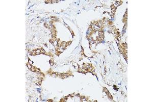 Immunohistochemistry of paraffin-embedded human lung cancer using Hsc70/HSP Rabbit pAb (ABIN3016123, ABIN3016124, ABIN3016125 and ABIN6219558) at dilution of 1:250 (40x lens).