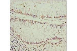 Immunohistochemistry of paraffin-embedded human colon cancer using ABIN7163634 at dilution of 1:100 (PDGFRL anticorps  (AA 15-205))