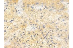 ABIN6264089 and ABIN6279283 at 1/100 staining human hepatocellular carcinoma by IHC-P. (PDE2A anticorps  (C-Term))