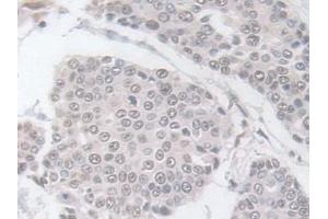 Detection of GPX3 in Human Prostate cancer Tissue using Polyclonal Antibody to Glutathione Peroxidase 3, Plasma (GPX3)