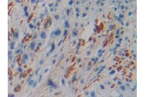 Detection of FLNC in Human Prostate cancer Tissue using Polyclonal Antibody to Filamin C Gamma (FLNC)