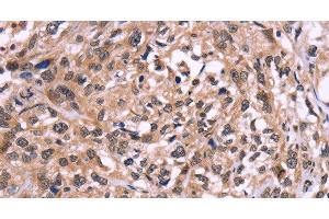 Immunohistochemistry of paraffin-embedded Human esophagus cancer using AMIGO2 Polyclonal Antibody at dilution of 1:50