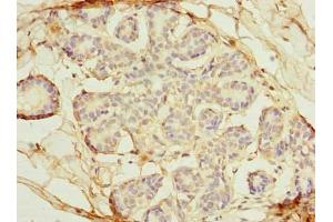 Immunohistochemistry of paraffin-embedded human breast cancer using ABIN7162370 at dilution of 1:100