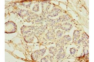 Immunohistochemistry of paraffin-embedded human breast cancer using ABIN7162370 at dilution of 1:100 (OSGIN2 anticorps  (AA 1-250))