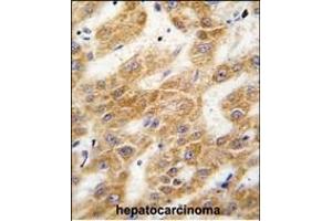 Formalin-fixed and paraffin-embedded human hepatocarcinoma tissue reacted with ALDH4A1 antibody (C-term), which was peroxidase-conjugated to the secondary antibody, followed by DAB staining. (ALDH4A1 anticorps  (C-Term))