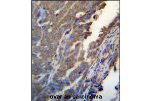 ASB4 Antibody (C-term) (ABIN657170 and ABIN2846303) immunohistochemistry analysis in formalin fixed and paraffin embedded human ovarian carcinoma followed by peroxidase conjugation of the secondary antibody and DAB staining.