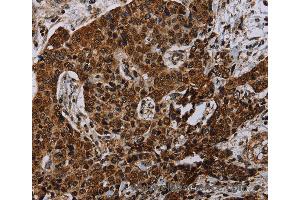 Immunohistochemistry of Human liver cancer using NDUFA4 Polyclonal Antibody at dilution of 1:40 (NDUFA4 anticorps)