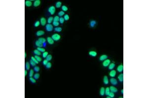 Immunofluorescent staining of human breast adenocarcinoma. (GATA3 anticorps)