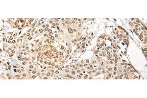 Immunohistochemistry of paraffin-embedded Human prost ate cancer tissue using BATF Polyclonal Antibody at dilution of 1:45(x200)