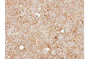 IHC-P Image Immunohistochemical analysis of paraffin-embedded SW480 xenograft, using MCCC2, antibody at 1:100 dilution. (MCCC2 anticorps  (Center))