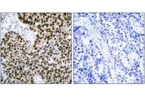 Immunohistochemistry analysis of paraffin-embedded human breast carcinoma tissue, using HSF1 (Ab-303) Antibody. (HSF1 anticorps  (AA 270-319))