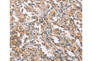 Immunohistochemistry of Human thyroid cancer using CHMP1A Polyclonal Antibody at dilution of 1:60 (CHMP1A anticorps)