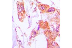 Immunohistochemical analysis of Involucrin staining in human lung cancer formalin fixed paraffin embedded tissue section. (Involucrin anticorps  (C-Term))