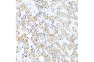 Immunohistochemistry of paraffin-embedded human liver injury using CHD1 antibody at dilution of 1:100 (x40 lens). (CHD1 anticorps)