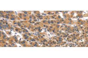 Immunohistochemistry of paraffin-embedded Human liver cancer tissue using UBTD2 Polyclonal Antibody at dilution 1:35 (UBTD2 anticorps)