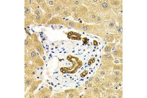 Immunohistochemistry of paraffin-embedded human liver injury using RAB27A antibody at dilution of 1:200 (400x lens). (RAB27A anticorps)