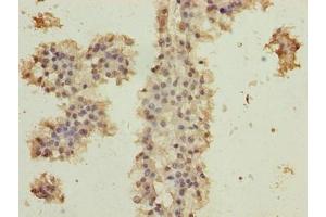 Immunohistochemistry of paraffin-embedded human breast cancer using ABIN7174707 at dilution of 1:100 (RPAP2 anticorps  (AA 1-154))