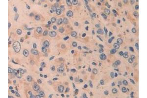 Detection of CYR61 in Human Prostate cancer Tissue using Polyclonal Antibody to Cysteine Rich Protein, Angiogenic Inducer 61 (CYR61)