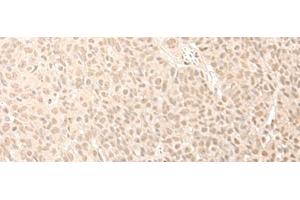 Immunohistochemistry of paraffin-embedded Human esophagus cancer tissue using CNOT10 Polyclonal Antibody at dilution of 1:50(x200) (CNOT10 anticorps)