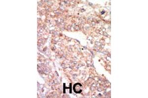 Formalin-fixed and paraffin-embedded human hepatocellular carcinoma tissue reacted with EPHA1 polyclonal antibody  , which was peroxidase-conjugated to the secondary antibody, followed by AEC staining. (EPHA1 anticorps  (N-Term))