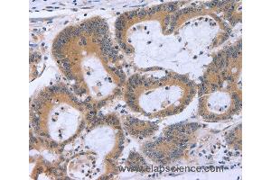 Immunohistochemistry of Human colon cancer using ECE1 Polyclonal Antibody at dilution of 1:30 (ECE1 anticorps)
