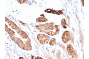 Formalin-fixed, paraffin-embedded human Breast Carcinoma stained with Flt3 / CD135 Mouse Monoclonal Antibody (FLT3/2458). (FLT3 anticorps)