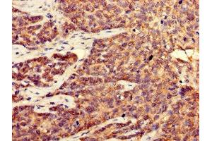 Immunohistochemistry of paraffin-embedded human ovarian cancer using ABIN7148931 at dilution of 1:100 (CDK5 anticorps  (AA 1-292))