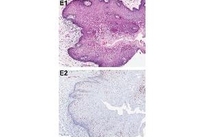 Immunohistochemical analysis of PDCD4 shows the corresponding H&E-stained and PDCD4-stained tissue sections from patients with OSCC.