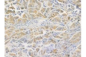 ABIN6260684 and ABIN6269374 at 1/100 staining human lung adenocarcinoma by IHC-P.