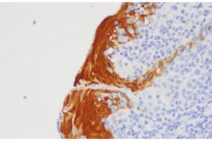 Immunohistochemistry of paraffin-embedded Human tonsil using S100A7 Polycloanl Antibody at dilution of 1:200 (S100A7 anticorps)