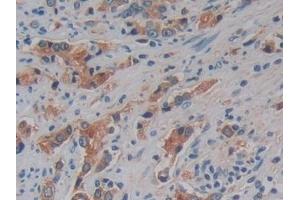 Detection of KLK10 in Human Prostate cancer Tissue using Polyclonal Antibody to Kallikrein 10 (KLK10)