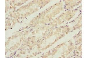 Immunohistochemistry of paraffin-embedded human gastric cancer using ABIN7146746 at dilution of 1:100 (CBR4 anticorps  (AA 1-237))