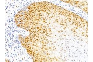 Formalin-fixed, paraffin-embedded human cervical cancer stained with p27 antibody (DCS-72. (CDKN1B anticorps)