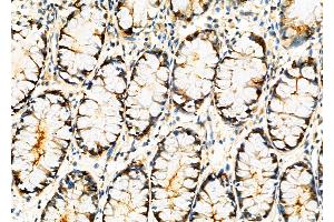 ABIN6261590 and ABIN6276833 at 1/100 staining Human colorectal cancer by IHC-P. (ERCC3 anticorps  (N-Term))