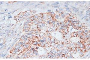 Immunohistochemistry of paraffin-embedded Human colon carcinoma using Desmoplakin Polyclonal Antibody at dilution of 1:100 (40x lens). (Desmoplakin anticorps)