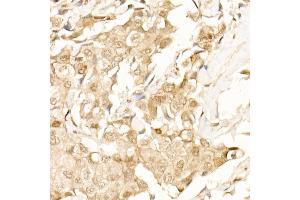 Immunohistochemistry of paraffin-embedded Human breast cancer using β-Catenin antibody (ABIN1684202, ABIN1512789, ABIN3020926 and ABIN3020928) at dilution of 25 (40x lens). (CTNNB1 anticorps)