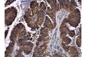 IHC-P Image STAT2 antibody [C2C3], C-term detects STAT2 protein at cytoplasm in human cervical carcinoma by immunohistochemical analysis.