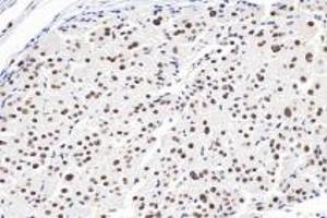 Immunohistochemistry analysis of paraffin-embedded human liver cancer using Ring1A (ABIN7075467) at dilution of 1: 3600