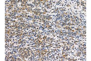 ABIN7095490 and ABIN7099547 at 1/100 staining human gastric cancer by IHC-P.