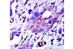 IHC analysis of FFPE human breast carcinoma tissue stained with the PLK1 antibody