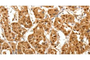 Immunohistochemistry of paraffin-embedded Human lung cancer tissue using TNN Polyclonal Antibody at dilution 1:40 (Tenascin N anticorps)