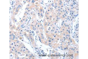 Immunohistochemistry of Human lung cancer using ARHGEF6 Polyclonal Antibody at dilution of 1:70 (ARHGEF6 anticorps)