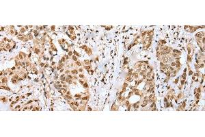 Immunohistochemistry of paraffin-embedded Human breast cancer tissue using ZNF486 Polyclonal Antibody at dilution of 1:50(x200) (ZNF486 anticorps)