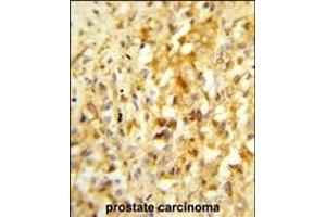 Formalin-fixed and paraffin-embedded human prostate carcinoma reacted with NKX3-1 Antibody (Center), which was peroxidase-conjugated to the secondary antibody, followed by DAB staining.