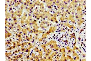 Immunohistochemistry of paraffin-embedded human liver cancer using ABIN7169191 at dilution of 1:100 (TAO Kinase 2 anticorps  (AA 719-880))